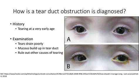 tear duct obstruction test|blocked duct diagnosis.